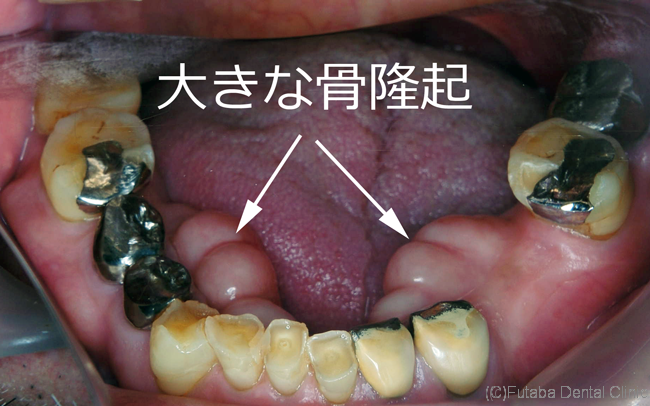 骨が腫れてきたんです 義歯が入らない  さいたま市北区 宮原町 日進町 