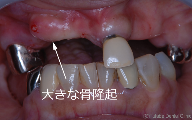骨が腫れてきたんです 義歯が入らない  さいたま市北区 宮原町 日進町 
