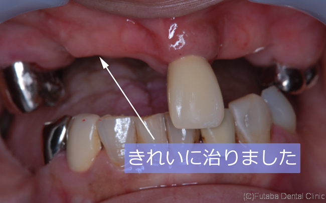 骨が腫れてきたんです 義歯が入らない  さいたま市北区 宮原町 日進町 