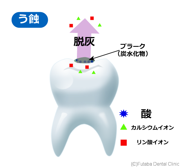 虫歯で歯が溶ける 酸で歯が溶ける さいたま市北区 宮原町 日進町 歯医者 雙葉デンタルクリニック