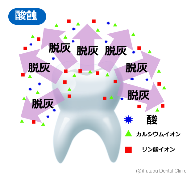 虫歯で歯が溶ける 酸で歯が溶ける さいたま市北区 宮原町 日進町 歯医者 雙葉デンタルクリニック
